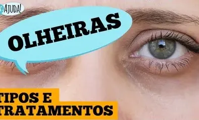 Olheiras: por que aparecem e o que fazer