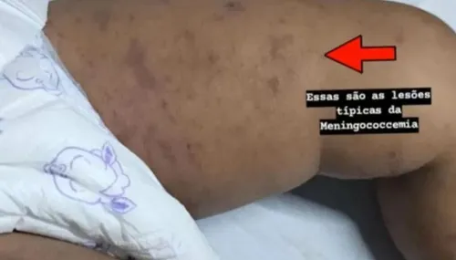 Papanduva registra caso de criança acometida de meningite bacteriana; caso reforça alerta sobre vacinação