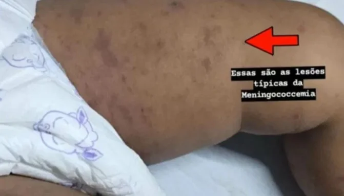 Papanduva registra caso de criança acometida de meningite bacteriana; caso reforça alerta sobre vacinação