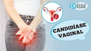 Imagem para matéria Candidíase Vaginal: o que é, sintomas, diagnóstico, tratamento e prevenção 